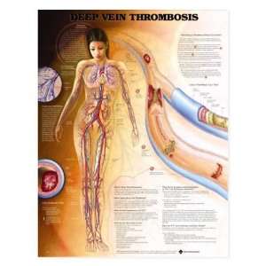 DVT Deep Vein Thrombosis DVT Chart  Industrial 